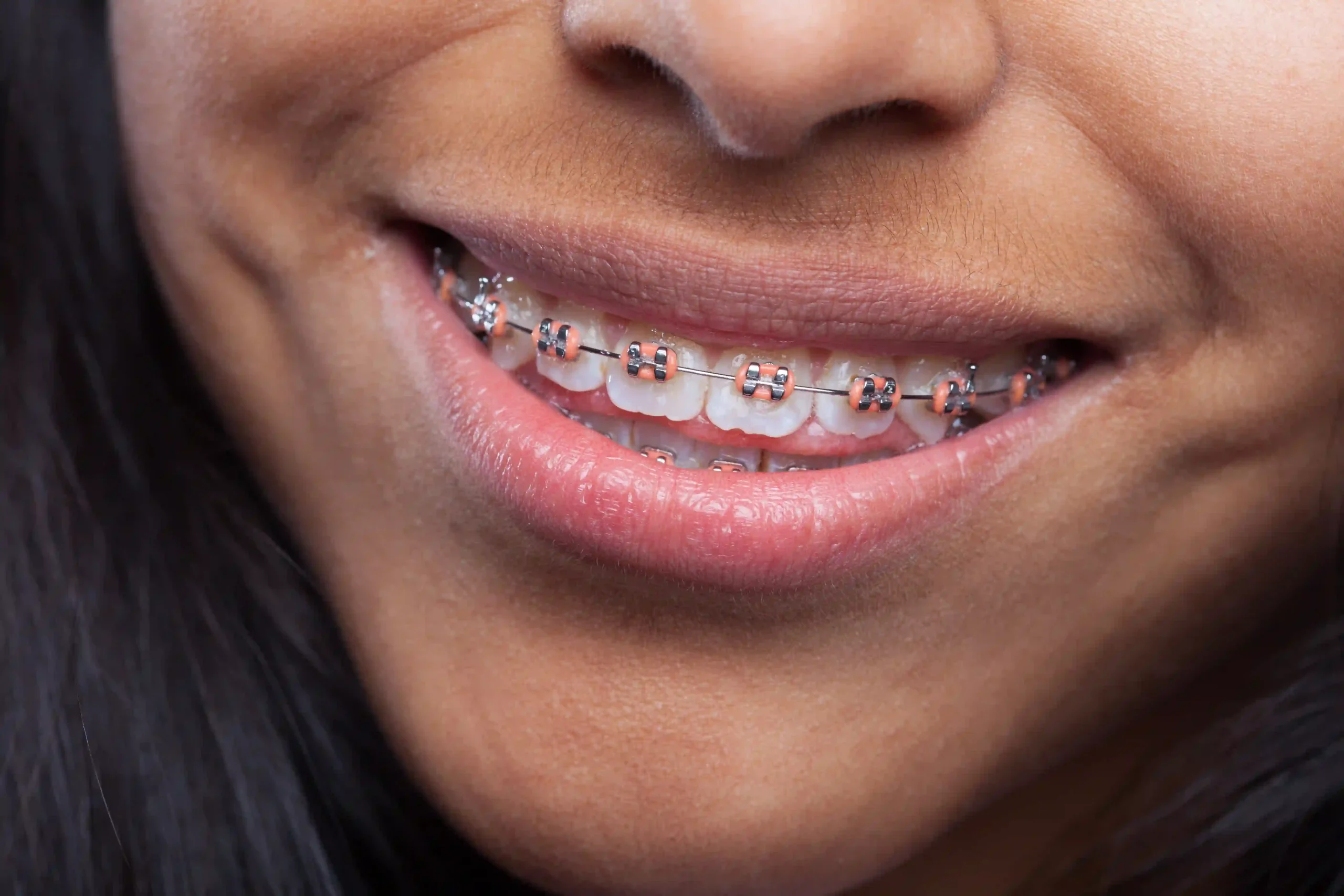 women smiling with dental braces
