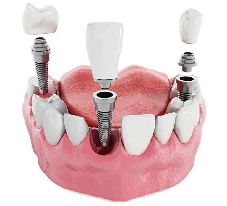 dental implant
