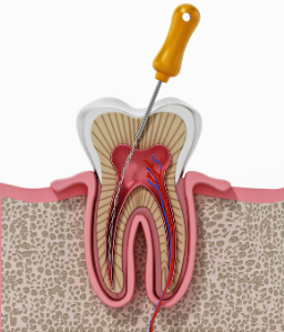 Root Canal Treatment