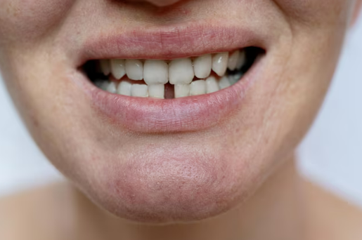 teeth gap